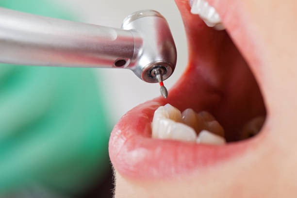 Best Emergency Wisdom Teeth Removal in Ridgeville, SC